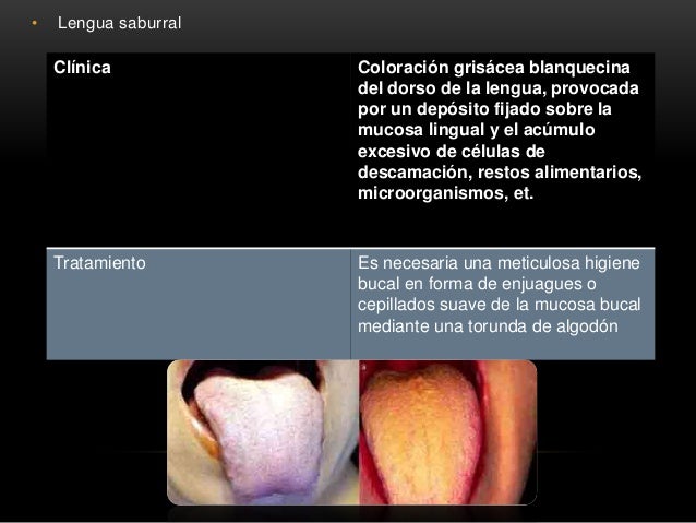 anquiloglosia nios